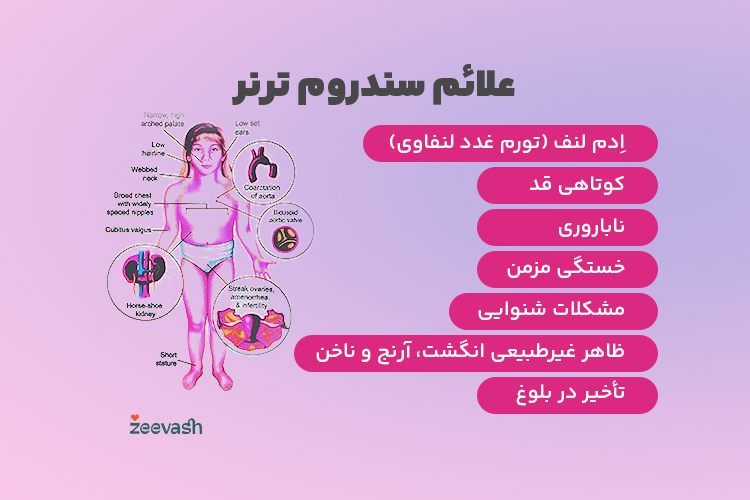 علائم سندروم ترنر